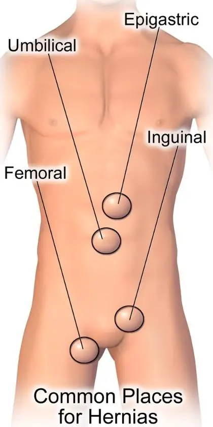 Common Types Of Hernias